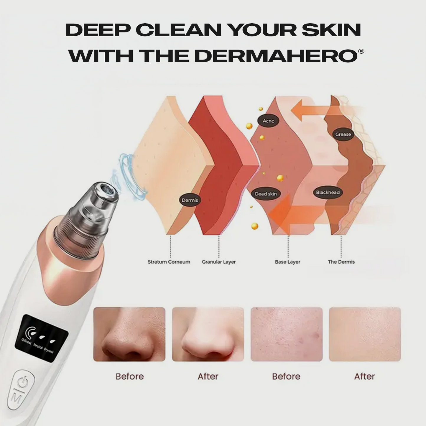 DermaHero™ Blackhead Vacuum